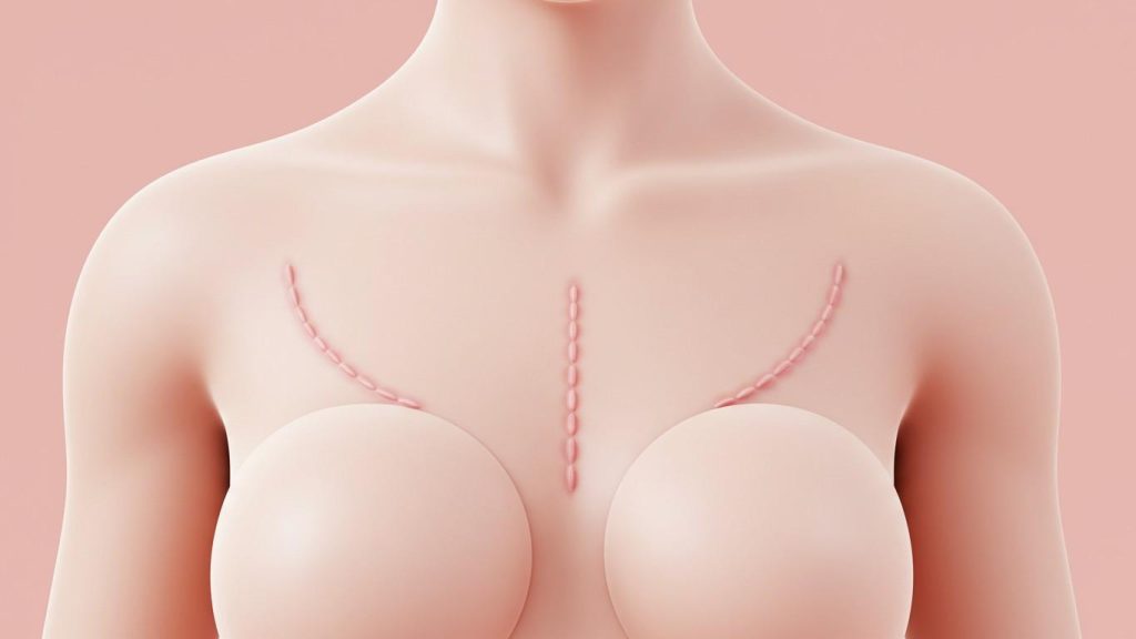 riski i vosstanovlenie posle uvelichenija grudi 2